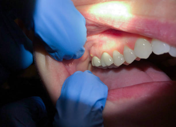 Best Emergency Treatment for Dental Infections or Abscesses in Prairie Ridge, WA